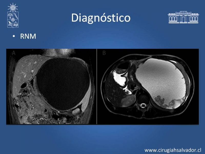 Diapositiva 12 de Quistes esplénicos