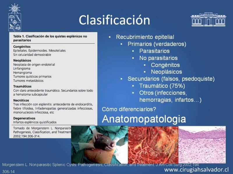 Diapositiva 6 de Quistes esplénicos