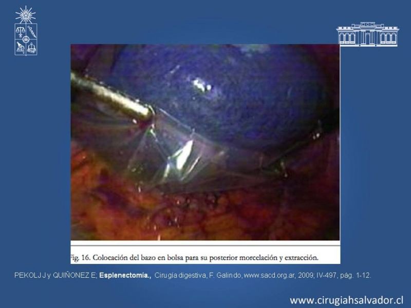 Diapositiva 20 de Quistes esplénicos