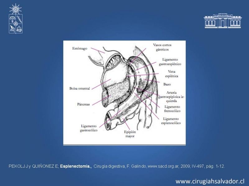Diapositiva 18 de Quistes esplénicos