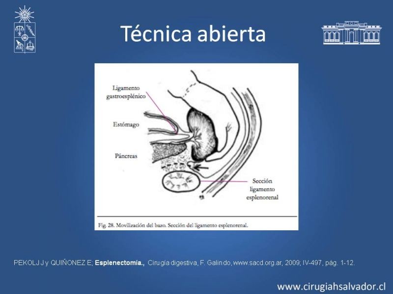 Diapositiva 22 de Quistes esplénicos