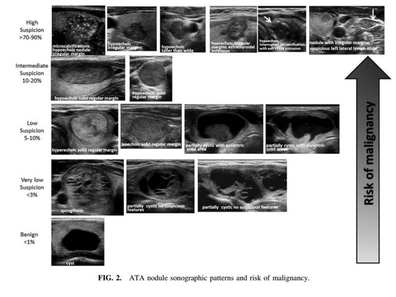 Diapositiva 9 de Nódulo Tiroídeo