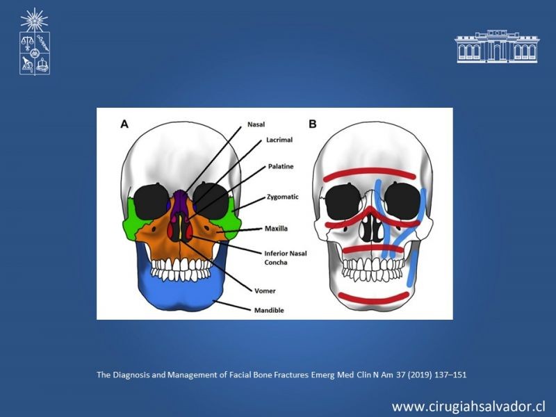Diapositiva 5 de Trauma Maxilofacial