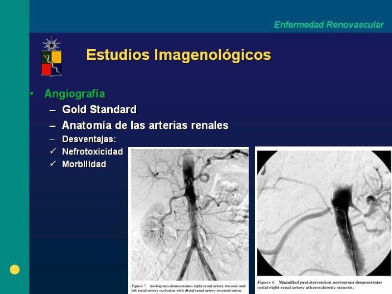 Diapositiva 11 de Enfermedad renovascular (ERV)