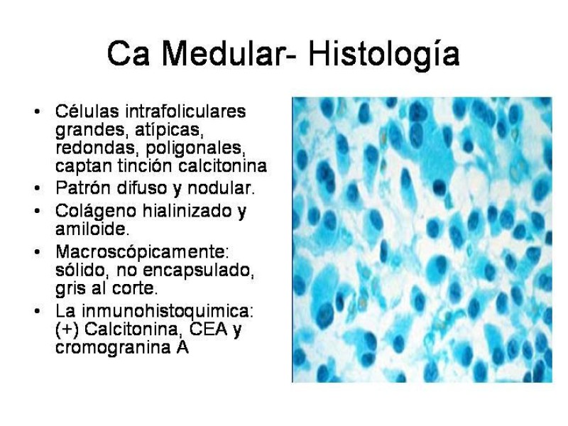 Diapositiva 33 de Cáncer de Tiroides