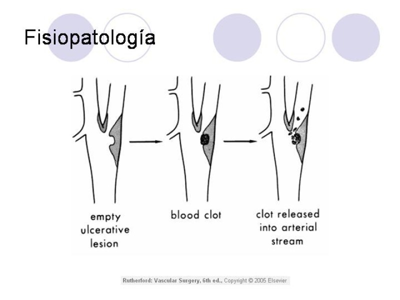 Diapositiva 4 de Estenosis Carotidea Endarterectomía y Angioplastía