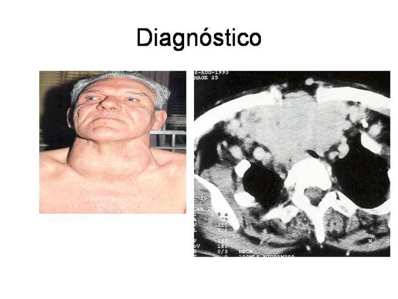 Diapositiva 14 de Cáncer de Tiroides