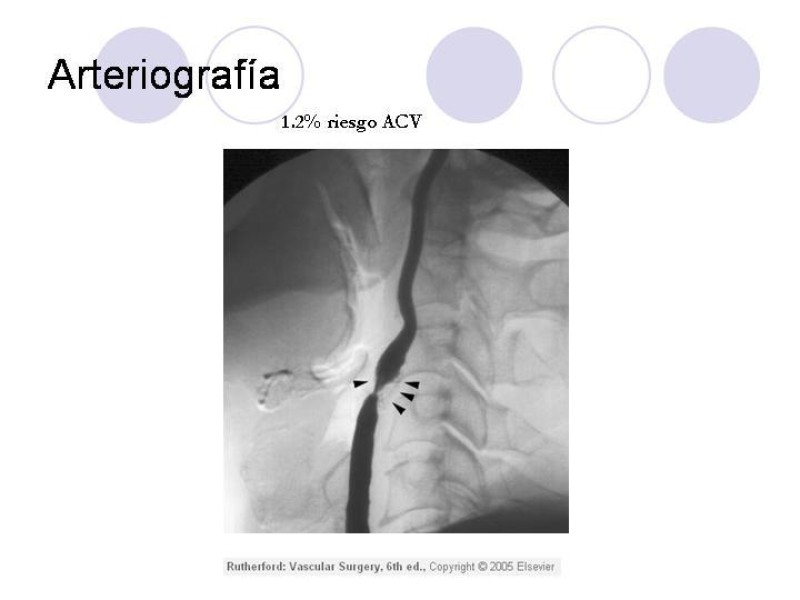 Diapositiva 6 de Estenosis Carotidea Endarterectomía y Angioplastía