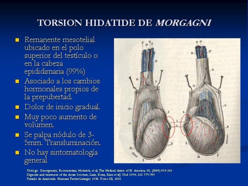 Diapositiva 12 de Síndrome de escroto agudo