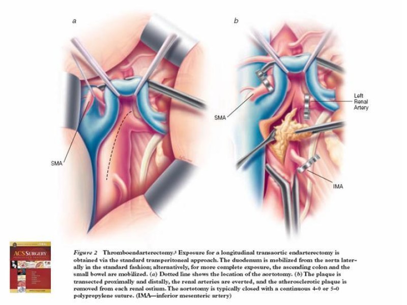 Diapositiva 25 de Enfermedad renovascular (ERV)