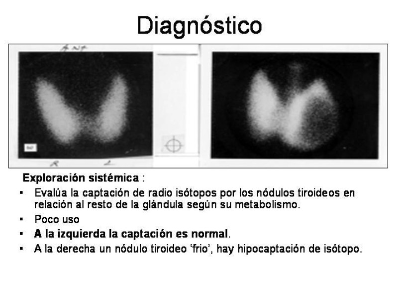 Diapositiva 10 de Cáncer de Tiroides
