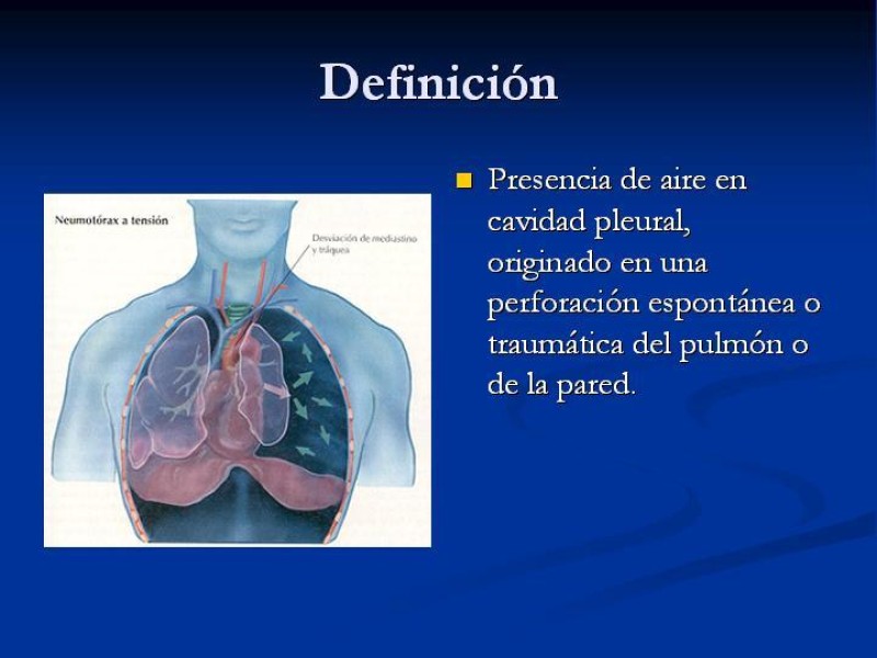Diapositiva 3 de Neumotórax Primario