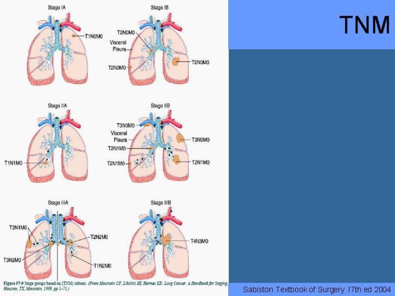 Diapositiva 29 de Cáncer Pulmonar