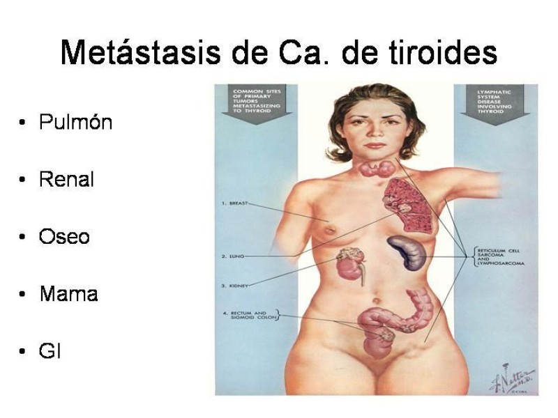 Diapositiva 16 de Cáncer de Tiroides