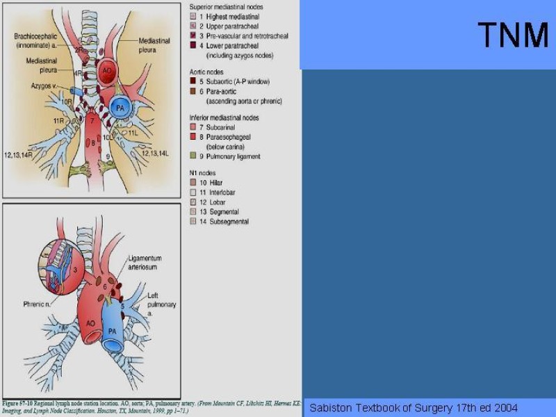 Diapositiva 31 de Cáncer Pulmonar