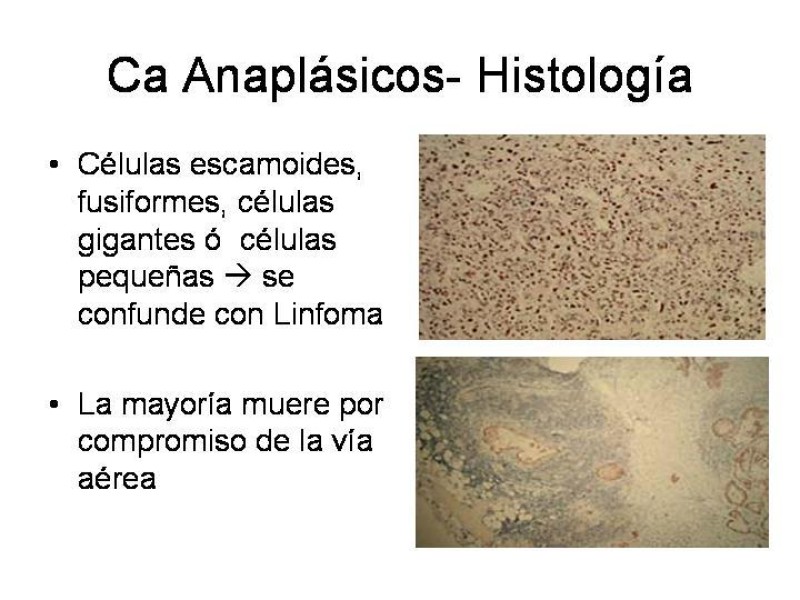 Diapositiva 39 de Cáncer de Tiroides