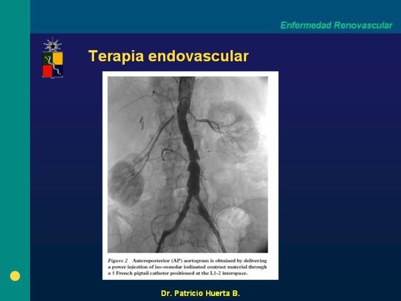 Diapositiva 19 de Enfermedad renovascular (ERV)