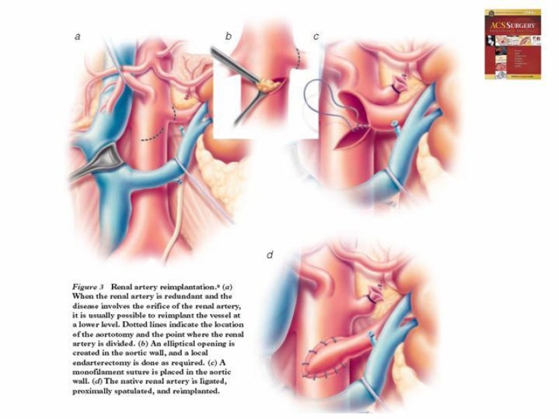 Diapositiva 26 de Enfermedad renovascular (ERV)
