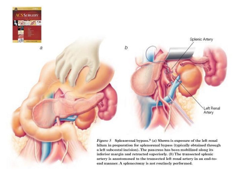 Diapositiva 28 de Enfermedad renovascular (ERV)