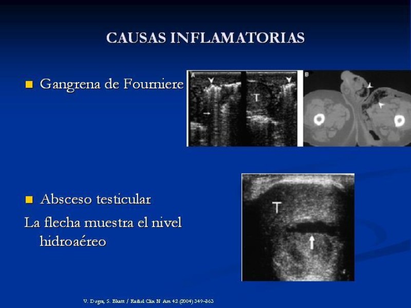 Diapositiva 21 de Síndrome de escroto agudo