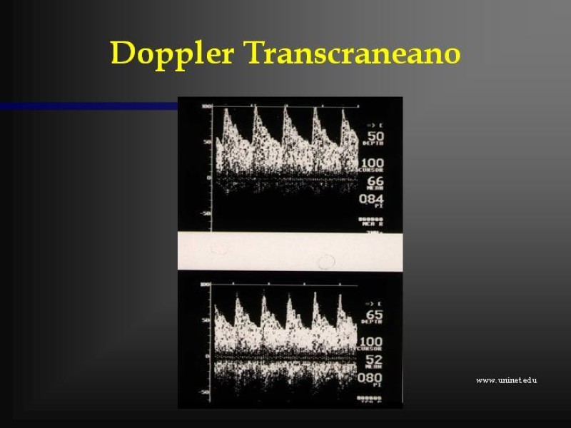Diapositiva 28 de Muerte cerebral