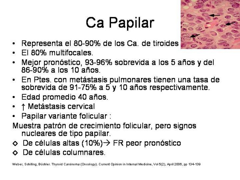 Diapositiva 18 de Cáncer de Tiroides