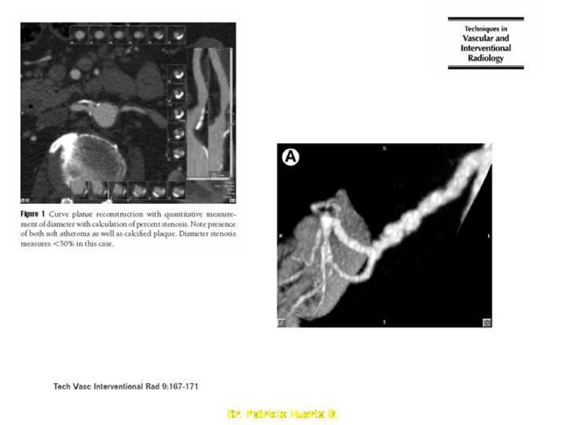 Diapositiva 13 de Enfermedad renovascular (ERV)