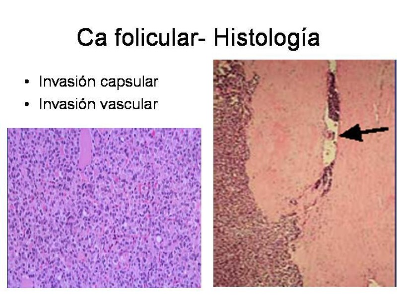 Diapositiva 23 de Cáncer de Tiroides