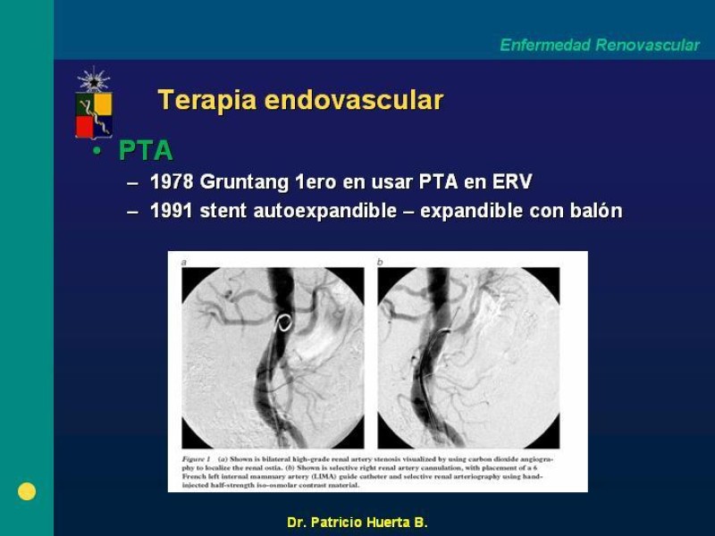 Diapositiva 18 de Enfermedad renovascular (ERV)