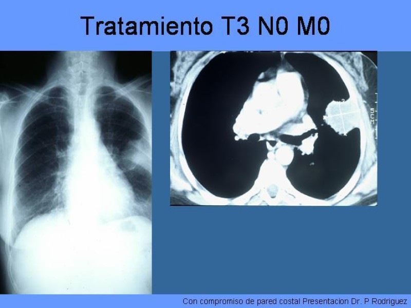 Diapositiva 36 de Cáncer Pulmonar