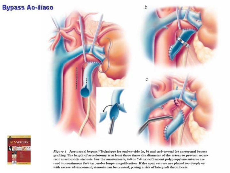Diapositiva 24 de Enfermedad renovascular (ERV)
