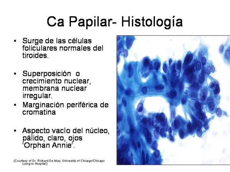 Diapositiva 19 de Cáncer de Tiroides
