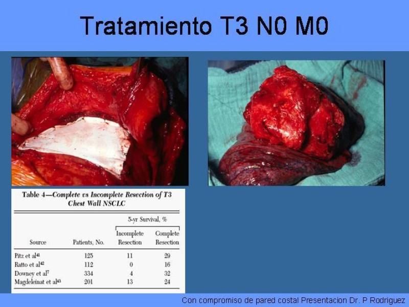 Diapositiva 39 de Cáncer Pulmonar
