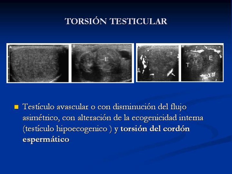 Diapositiva 9 de Síndrome de escroto agudo