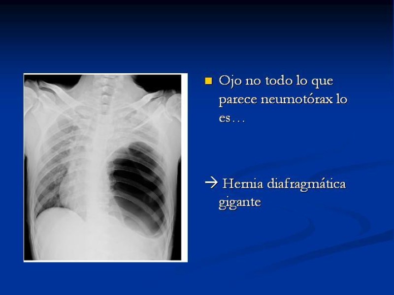 Diapositiva 22 de Neumotórax Primario