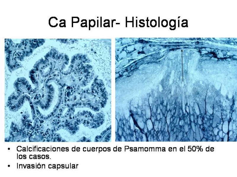 Diapositiva 20 de Cáncer de Tiroides
