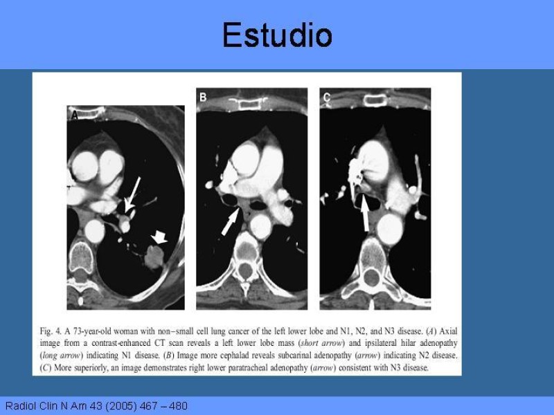 Diapositiva 25 de Cáncer Pulmonar