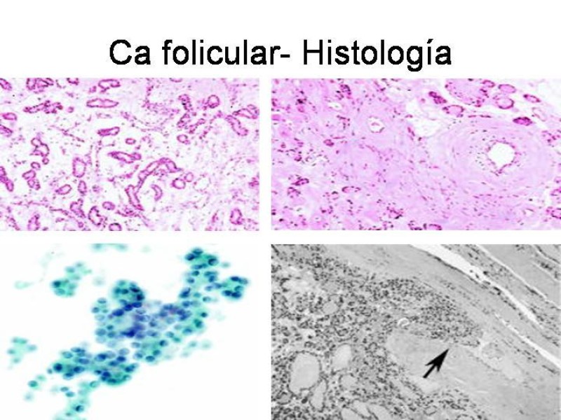 Diapositiva 24 de Cáncer de Tiroides