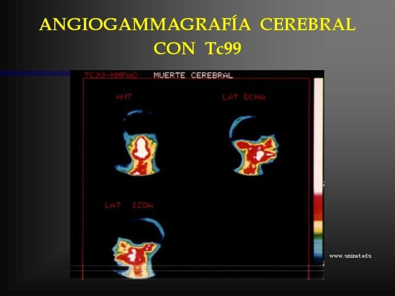 Diapositiva 30 de Muerte cerebral