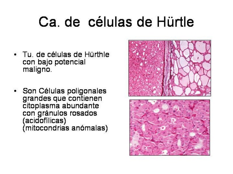 Diapositiva 26 de Cáncer de Tiroides
