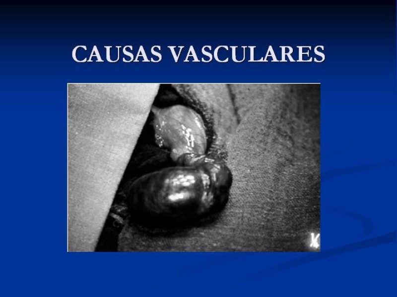 Diapositiva 4 de Síndrome de escroto agudo