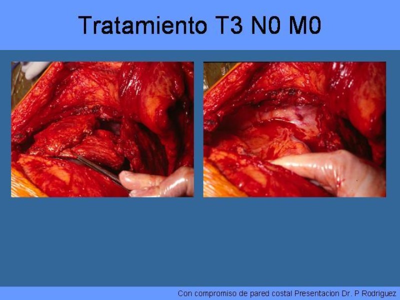 Diapositiva 38 de Cáncer Pulmonar