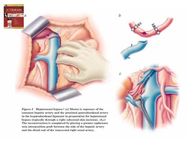 Diapositiva 27 de Enfermedad renovascular (ERV)