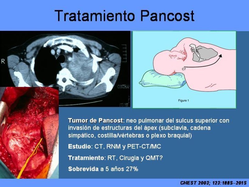 Diapositiva 40 de Cáncer Pulmonar