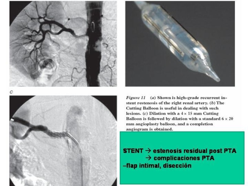 Diapositiva 21 de Enfermedad renovascular (ERV)