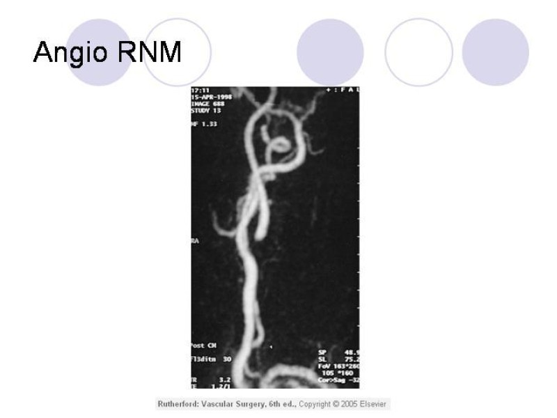 Diapositiva 9 de Estenosis Carotidea Endarterectomía y Angioplastía