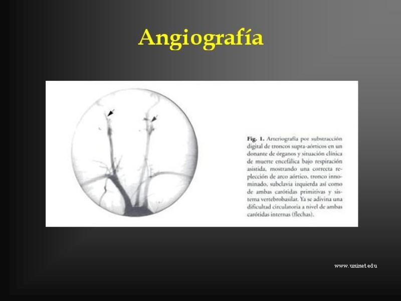 Diapositiva 27 de Muerte cerebral