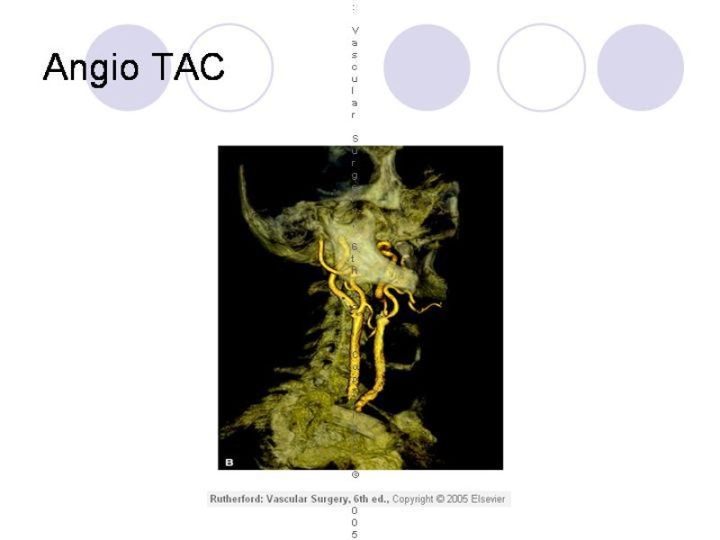 Diapositiva 8 de Estenosis Carotidea Endarterectomía y Angioplastía