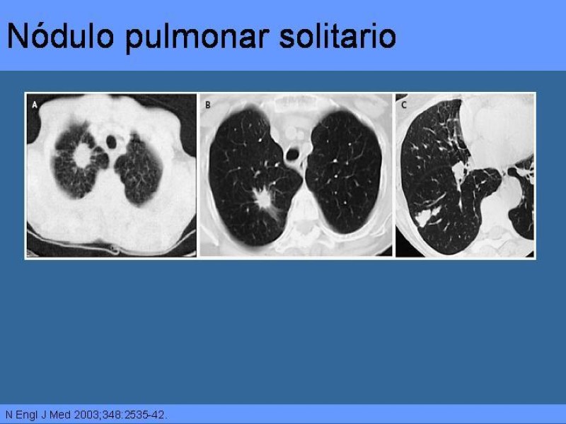 Diapositiva 15 de Cáncer Pulmonar