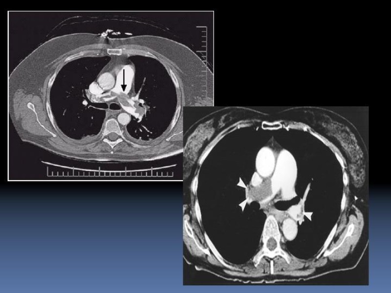 Diapositiva 18 de TEP y su profilaxis en cirugía